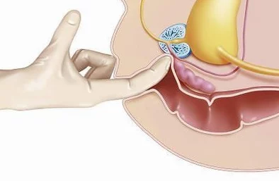 胡桃尿道口流出白色脓状物是什么？了解可能的原因与治疗方法，关心自己的健康尤为重要！