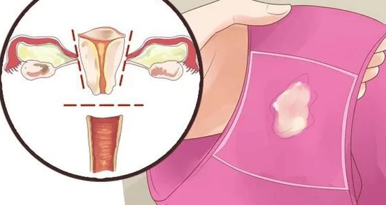 女生流出白白的东西怎么回事?了解可能的生理原因与健康建议,帮助你更好地认识身体变化 女生流出白白的东西怎么回事?了解可能的生理原因与健康建议,帮助你更好地认识身体变化